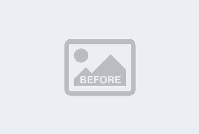 Before Image: Botox – Platysmal Bands (neck) -