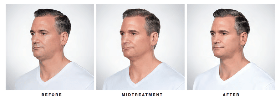 eliminate double chin with kybella