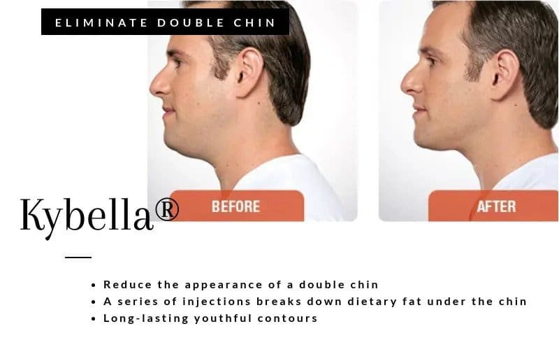 Kybella infographic featuring man before and after kybella treatment, less chin fat after procedure