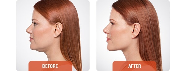 kybella before after 1