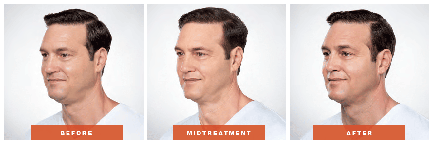 results from kybella treatments 0
