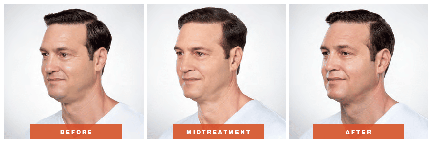How to get rid sales of face and neck fat