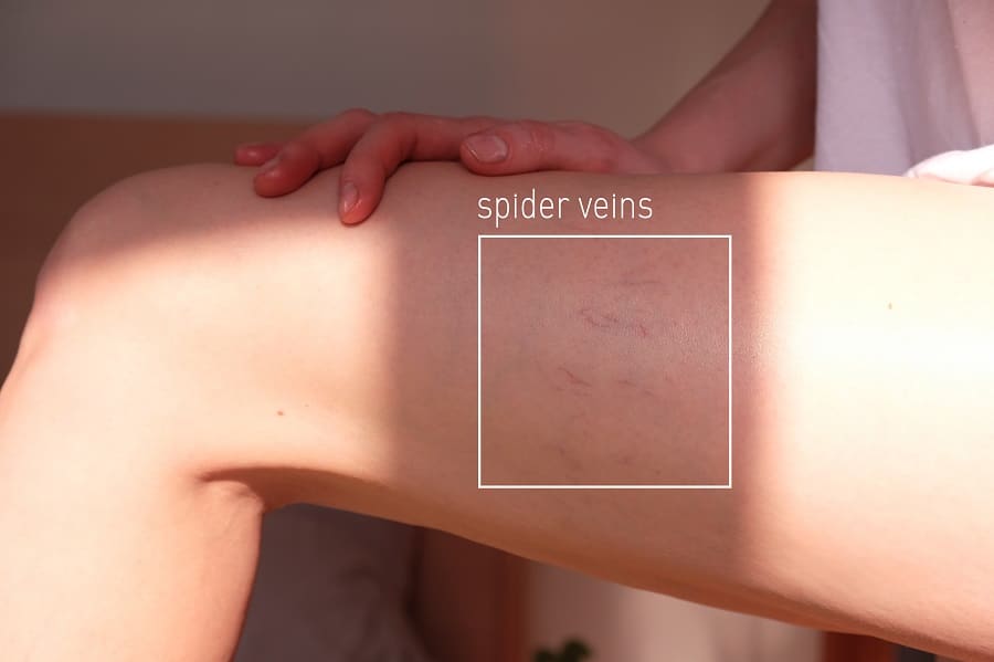 spider veins before sclerotherapy
