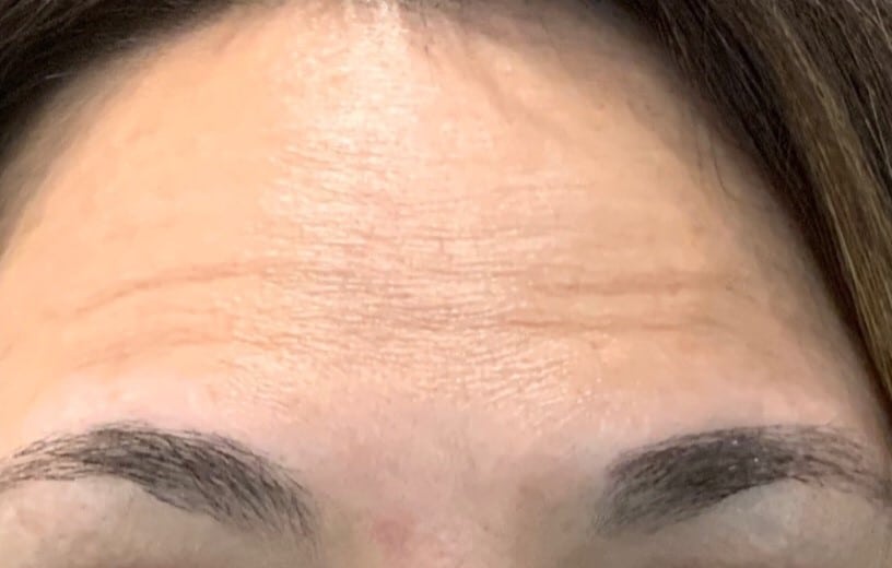 woman’s forehead after botox injections, fewer wrinkles after treatment