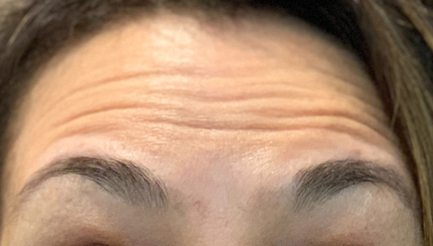 woman’s forehead before botox injections