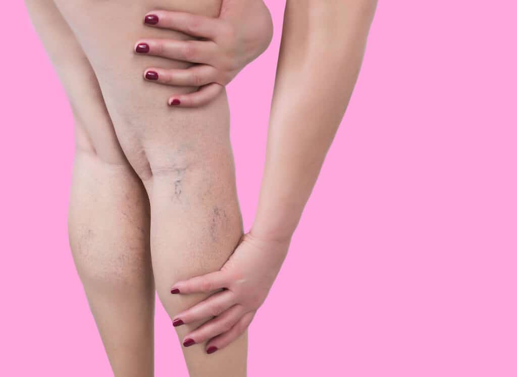 Varicose veins on the legs of woman.
