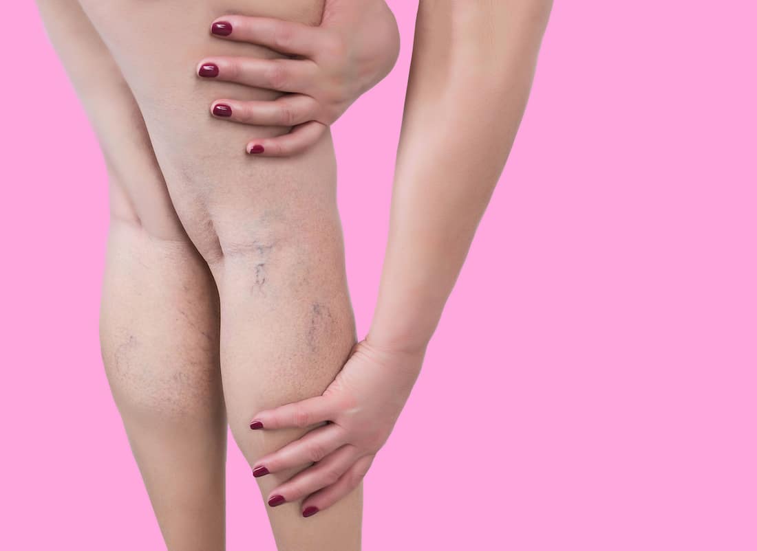 Varicose veins on the legs of woman.