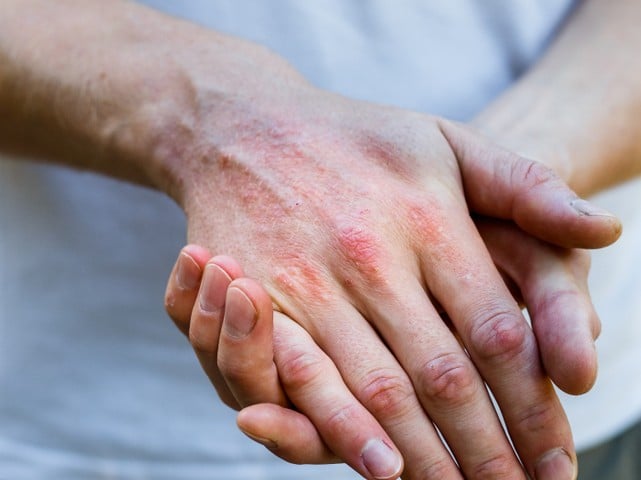 atopic dermatitis symptom skin detail texture