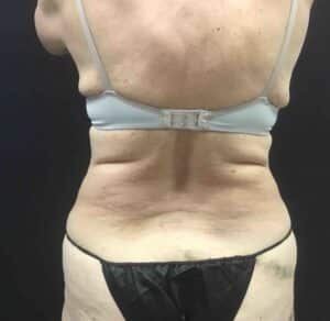 After Image: CoolSculpting – Lower Flanks (love handles)