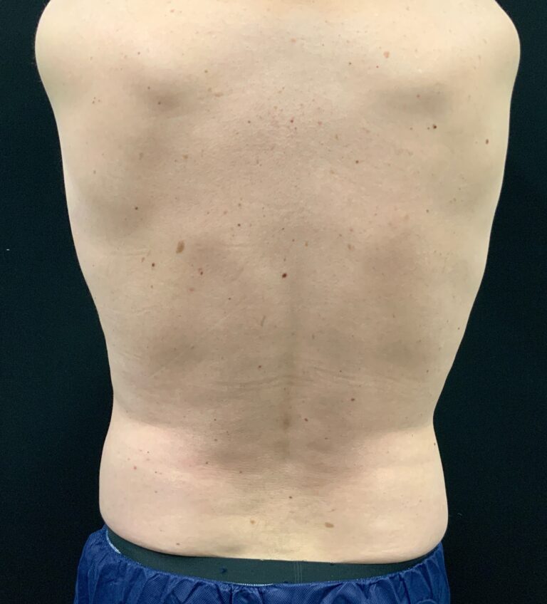 After Image: CoolSculpting – Lower Flanks - front
