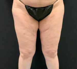 After Image: CoolSculpting – Inner Thighs