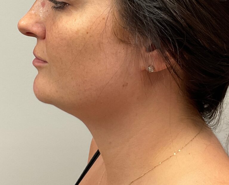 After Image: CoolSculpting – under chin (submental area) - front