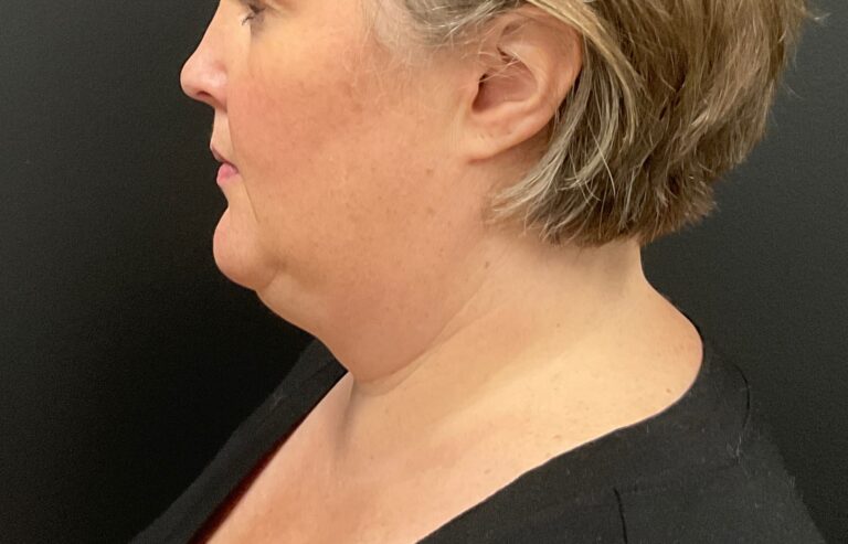 After Image: CoolSculpting – Submental (under chin) - front