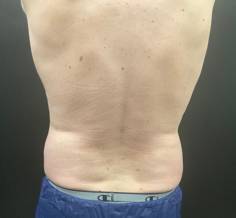 Before Image: CoolSculpting – Lower Flanks - front
