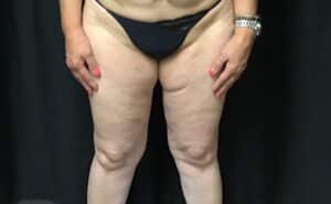 Before Image: CoolSculpting – Inner Thighs