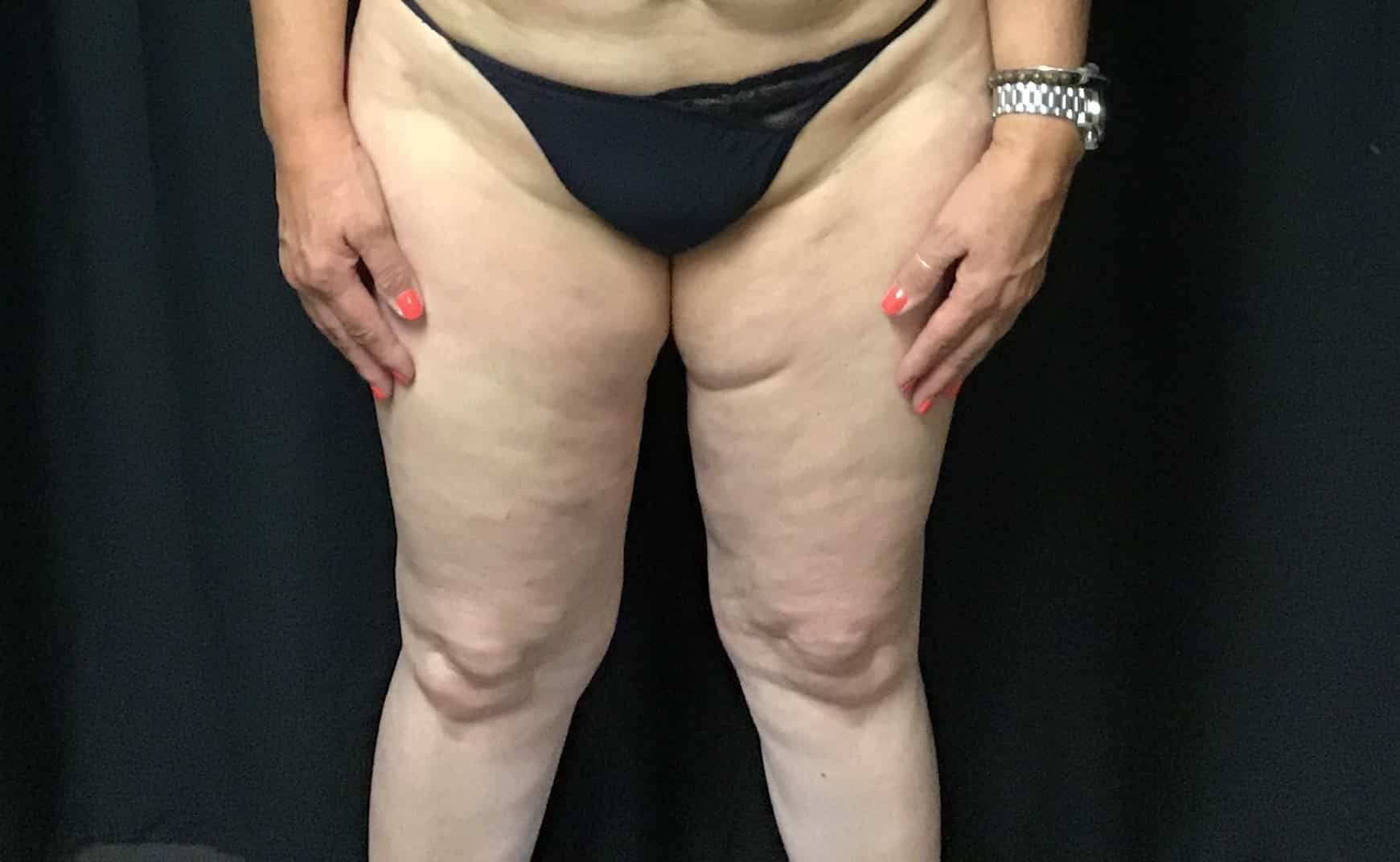 CoolSculpting – Inner Thighs