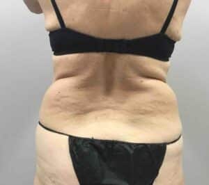 Before Image: CoolSculpting – Lower Flanks (love handles)