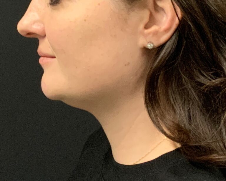 Before Image: CoolSculpting – under chin (submental area) - front
