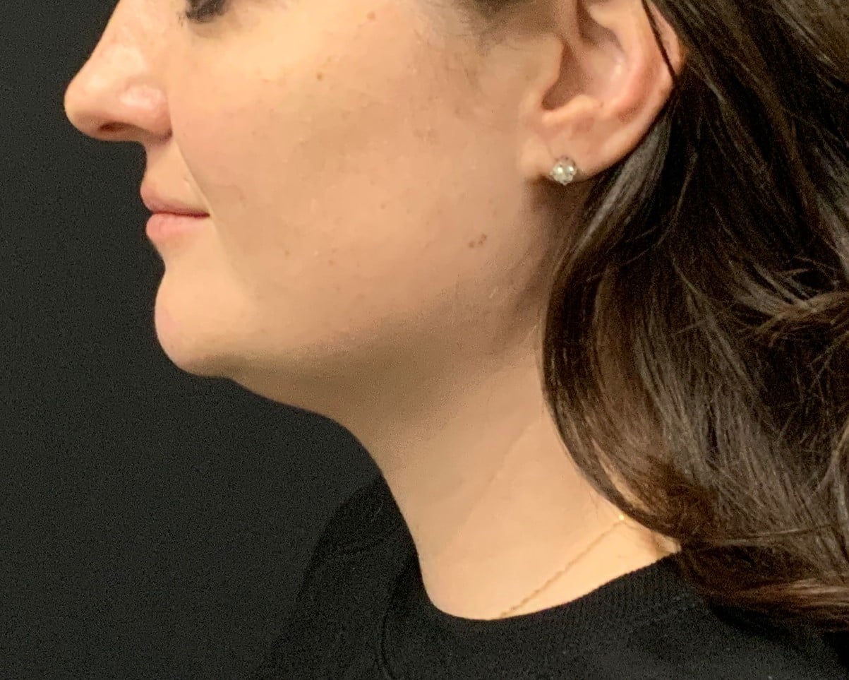Before Image: CoolSculpting – under chin (submental area) - front