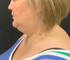CoolSculpting – Submental