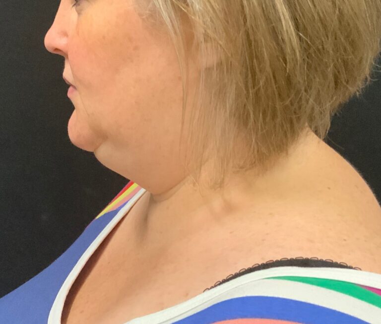 Before Image: CoolSculpting – Submental (under chin) - front