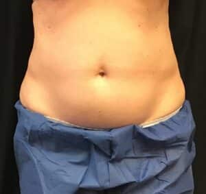 CoolSculpting – Abdomen