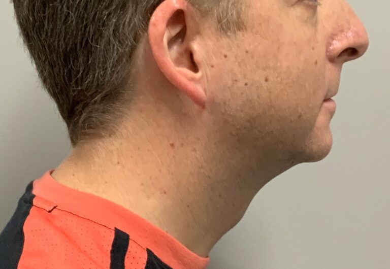 After Image: Kybella - front