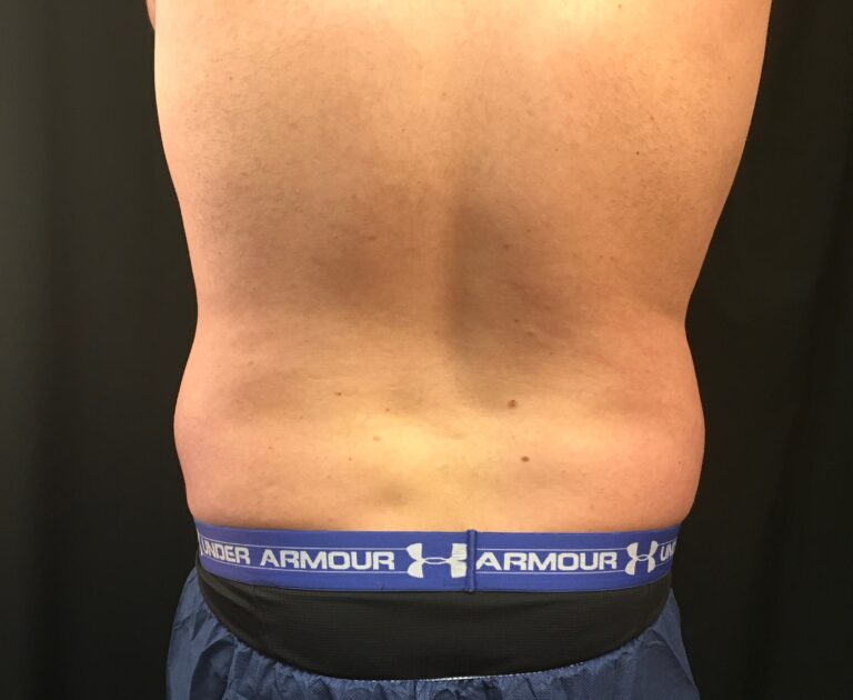 Before Image: CoolSculpting – Lower Flanks (love handles) - front