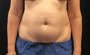 CoolSculpting – Abdomen