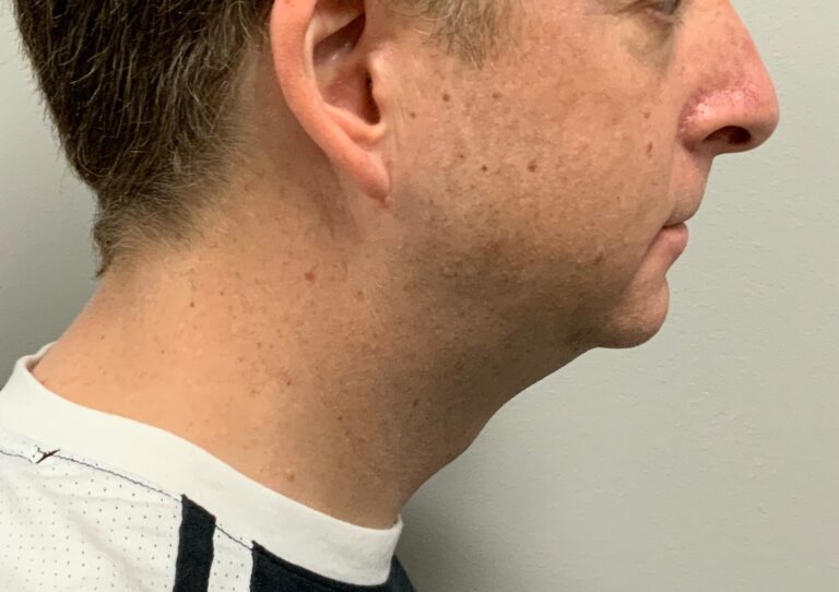 Before Image: Kybella - front