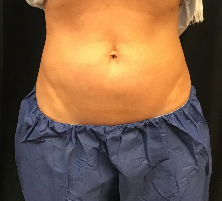 After Image: CoolSculpting – Upper and Lower Abdomen - front