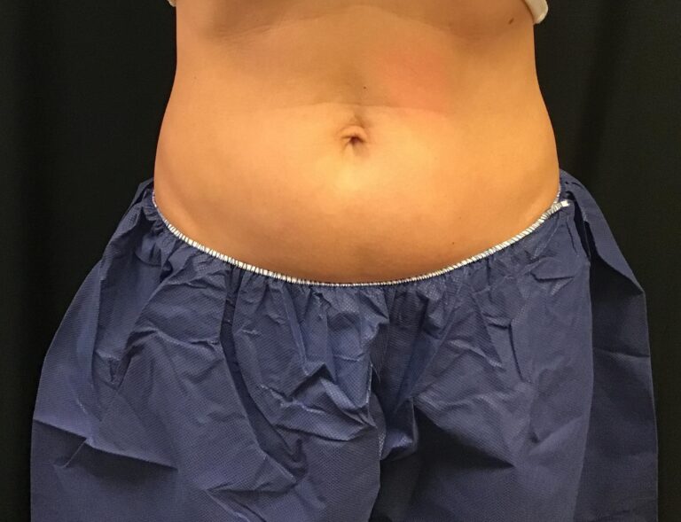 Before Image: CoolSculpting – Upper and Lower Abdomen - front
