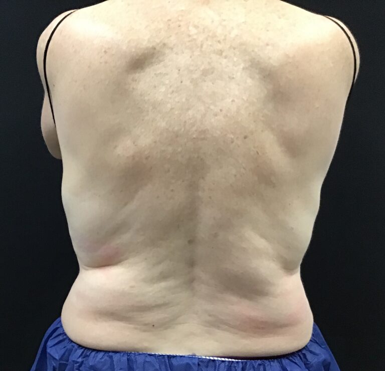 After Image: CoolSculpting – Upper Flanks / Bra strap area - front