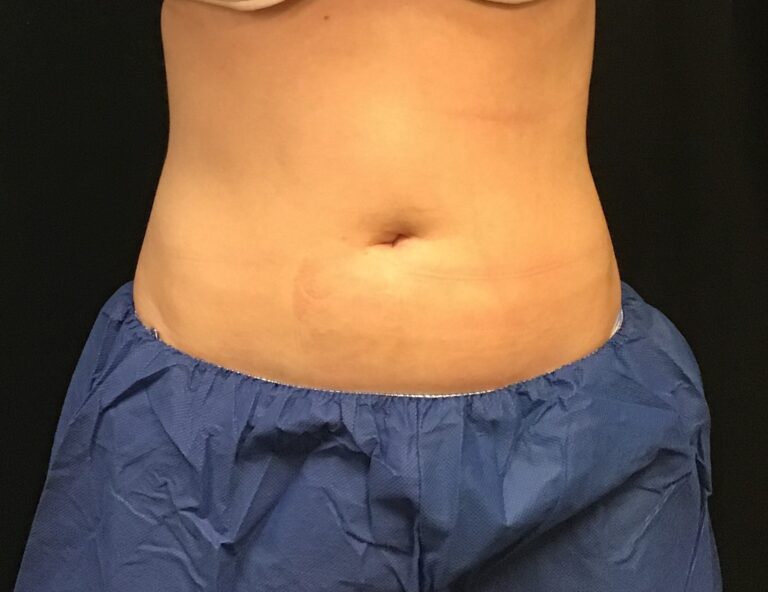 After Image: CoolSculpting – Abdomen - front
