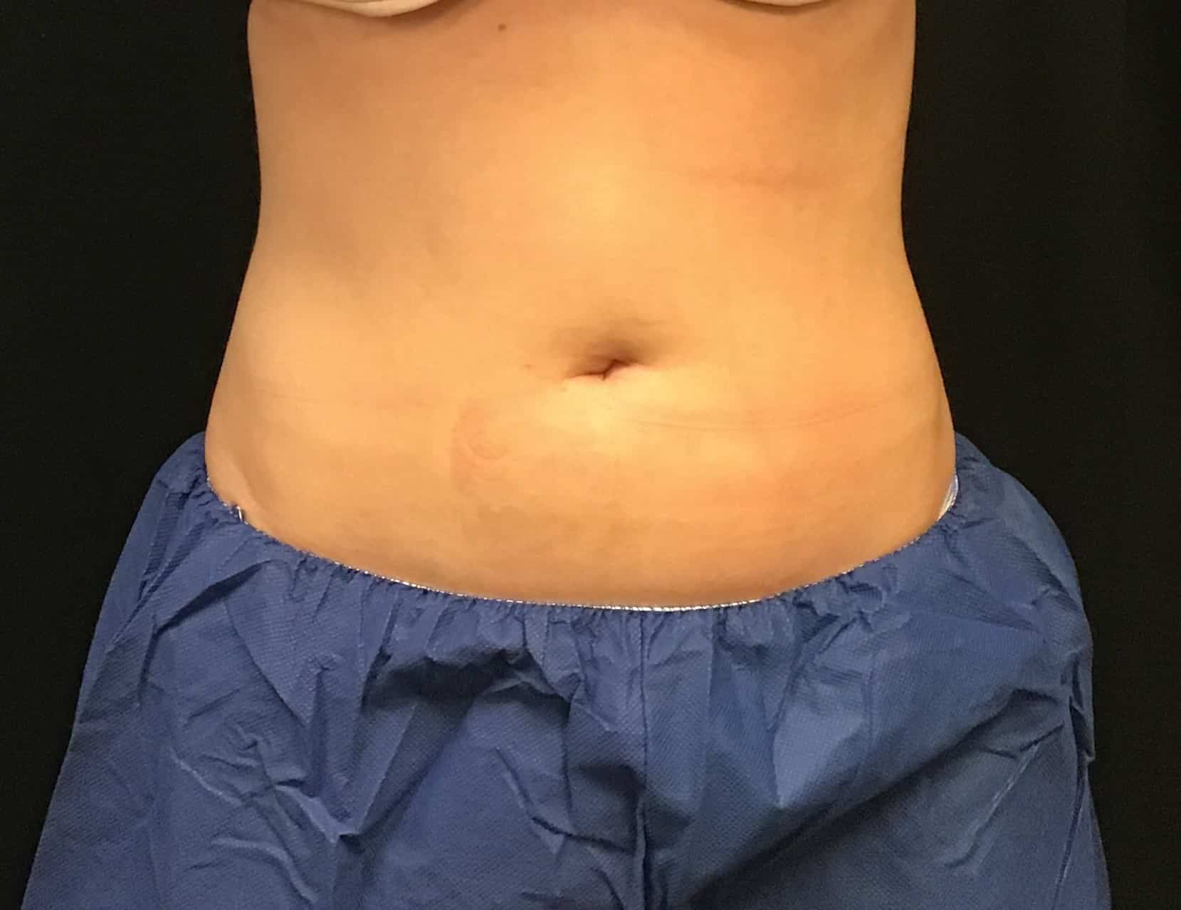 After Image: CoolSculpting – Abdomen - front