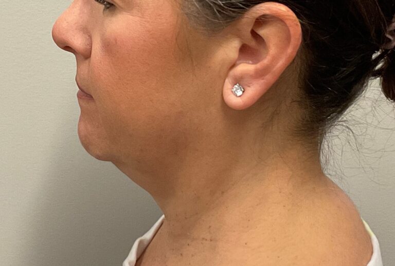 After Image: CoolSculpting – Submental (under chin) - front