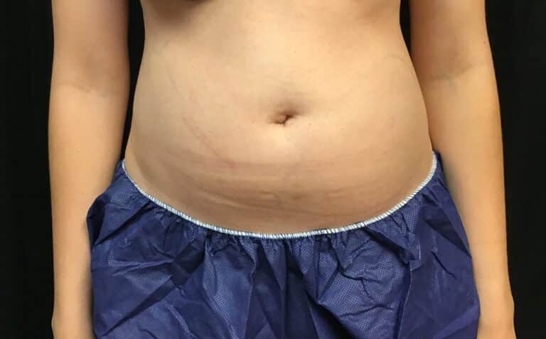 Before Image: CoolSculpting – Abdomen - front