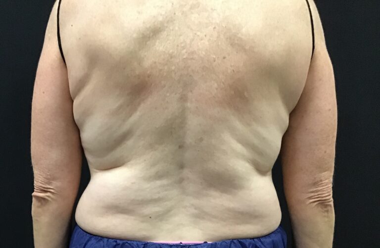 Before Image: CoolSculpting – Upper Flanks / Bra strap area - front