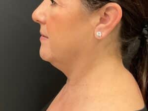 CoolSculpting – Submental