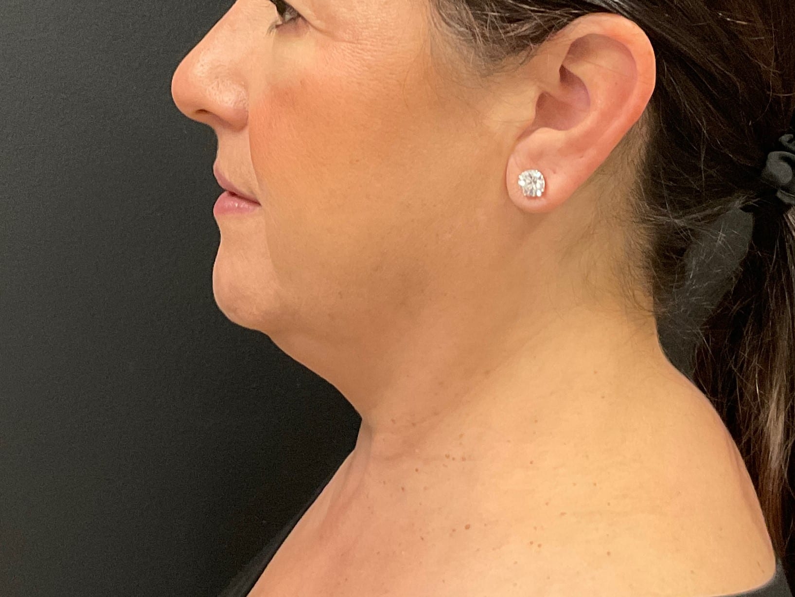 CoolSculpting – Submental