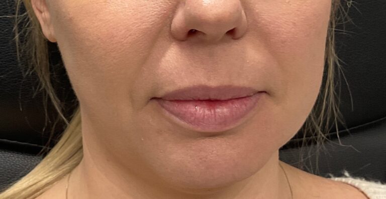 Before Image: Dermal Filler – Volbella (lips) - front