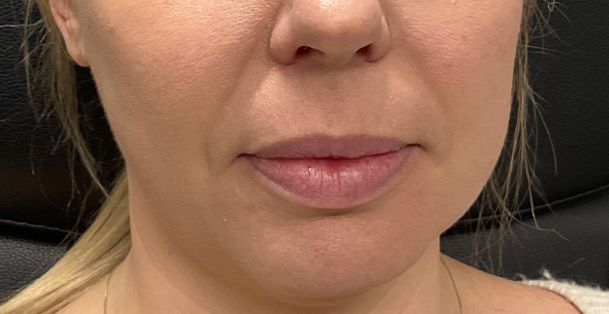 Dermal Filler – Volbella (lips)