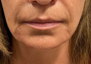Dermal Filler – Volbella (lips)