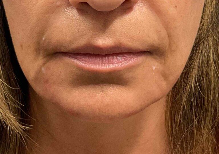 Before Image: Dermal Filler – Volbella (lips) - front