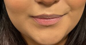 Before Image: Dermal Filler – Juvederm Ultra (lips)
