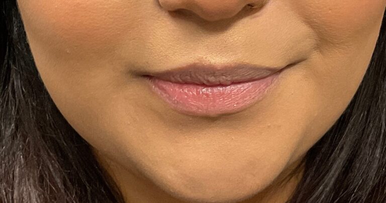 Before Image: Dermal Filler – Juvederm Ultra (lips) - front