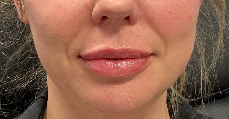 After Image: Dermal Filler – Volbella (lips) - front
