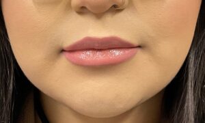 After Image: Dermal Filler – Juvederm Ultra (lips)