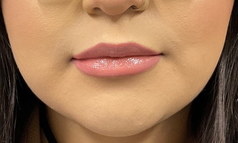 After Image: Dermal Filler – Juvederm Ultra (lips) - front