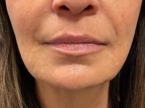 Dermal Filler – Volbella (lips)